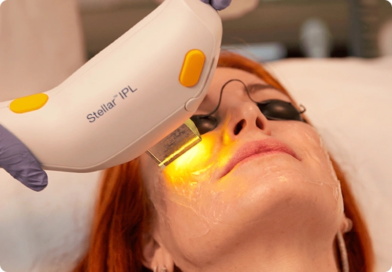 Stellar IPL Tratamiento